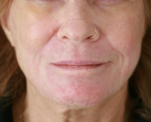 Feel Beautiful - Lip Wrinkles Smoothing - After Photo